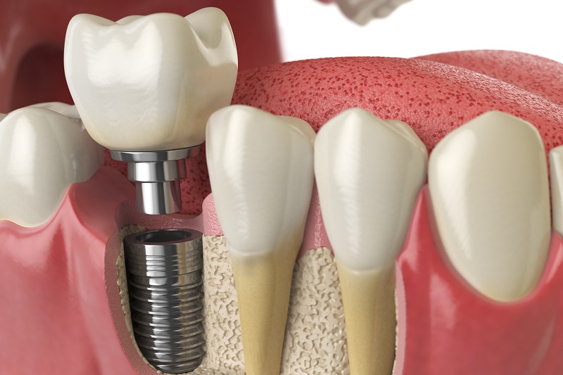 implant zębowy